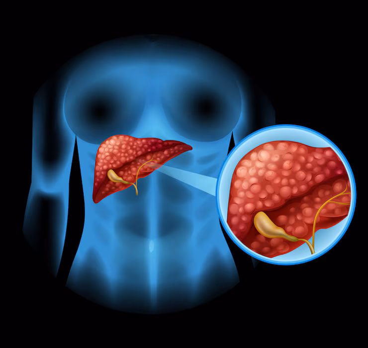 Cirurgia da Vesícula Biliar (Colecistectomia): Como é Feita e a Recuperação